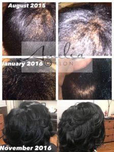 Central Centrifugal Cicatricial Alopecia